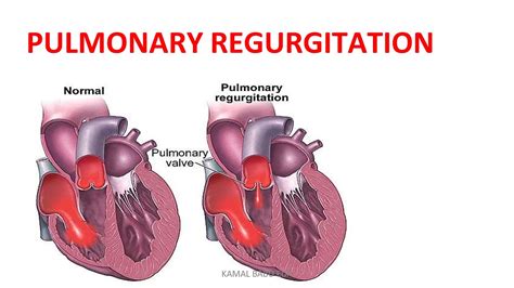 Healthy Aging Pulmonary Regurgitation